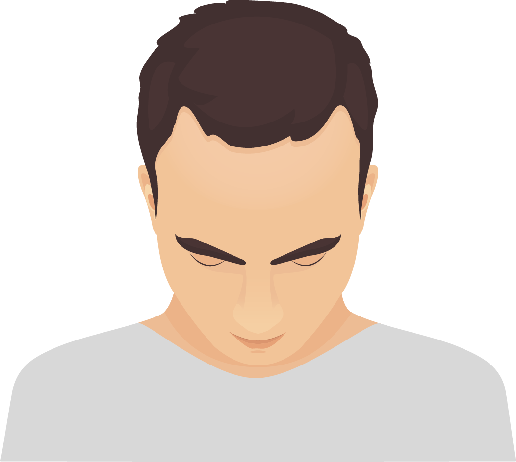 Alopecia diffusa