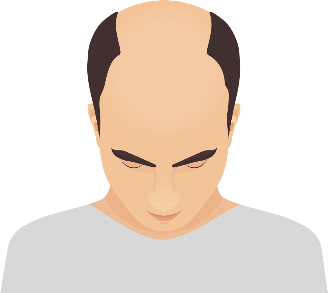 Alopecia androgenetica