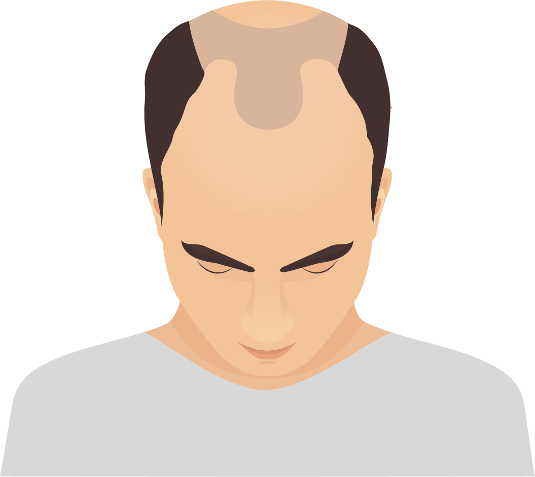 Alopecia traumatica