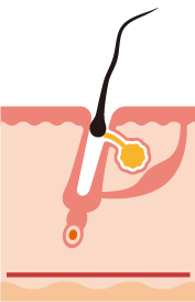 FASE TELOGEN (CADUTA)