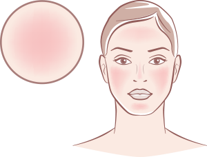 Rosacea o couperose